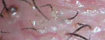 Morgellons-Hautauswchse, 160x